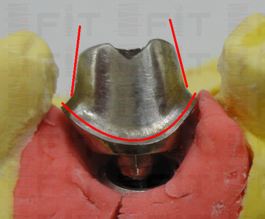 Custom Abutment - 客製化支台齒